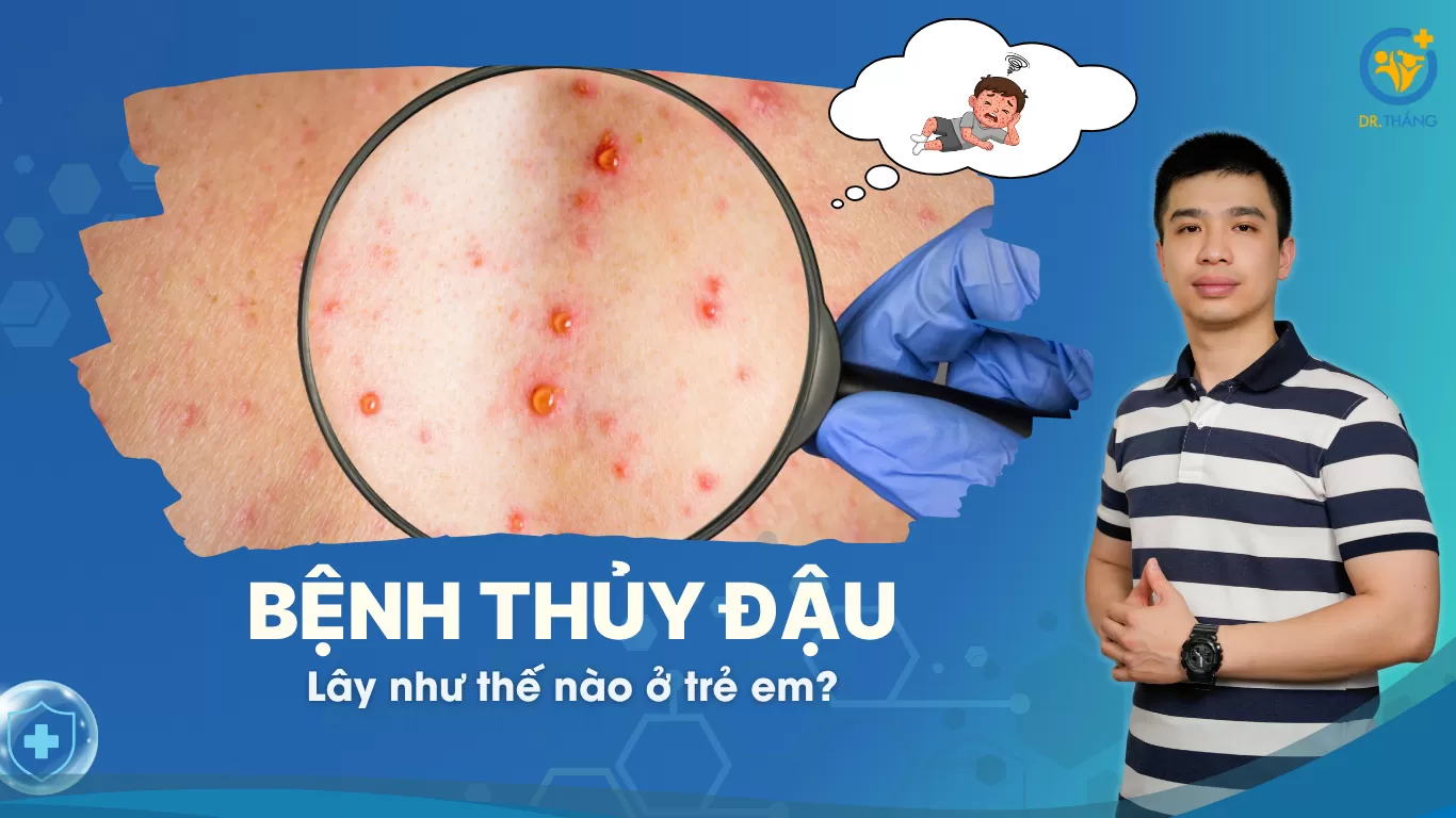 Bệnh thủy đậu lây như thế nào ở trẻ em?