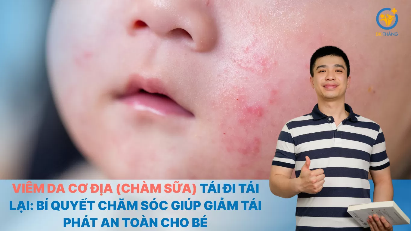 Viêm da cơ địa (chàm sữa) tái đi tái lại: Bí quyết chăm sóc giúp giảm tái phát an toàn cho bé