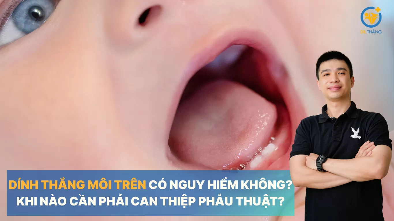 Dính thắng môi trên có nguy hiểm không? Khi nào cần phải can thiệp phẫu thuật?
