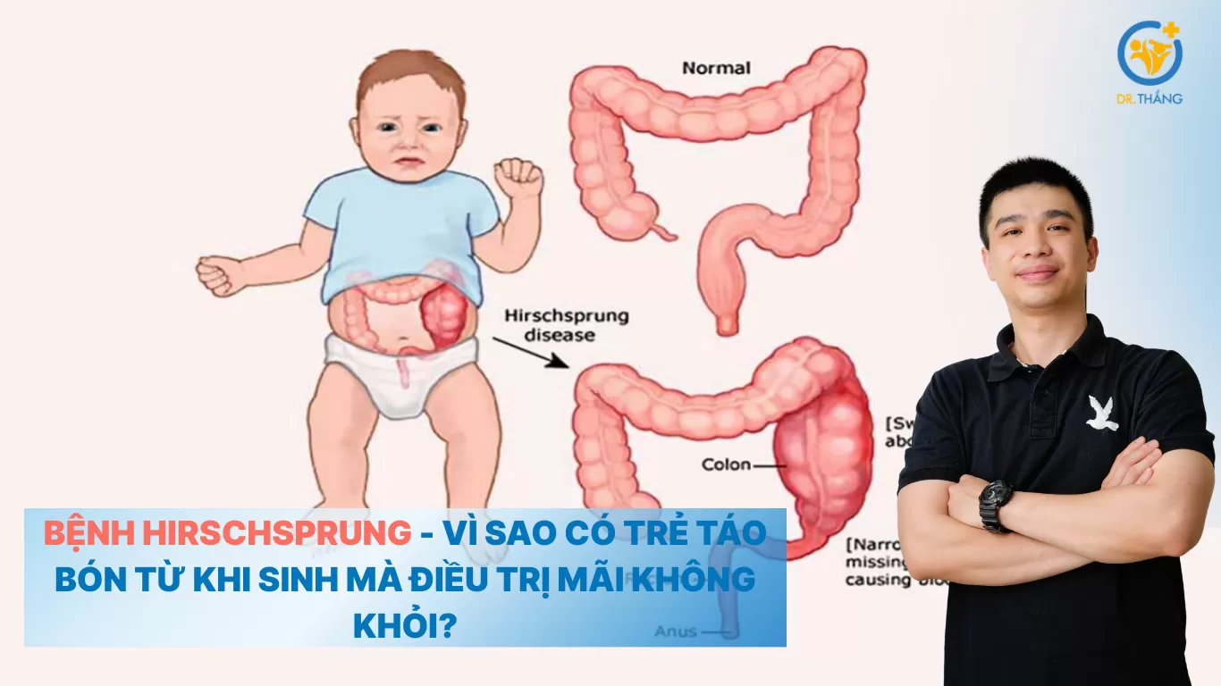 Bệnh Hirschsprung - Vì sao có trẻ táo bón từ lúc mới sinh mà điều trị mãi không khỏi?