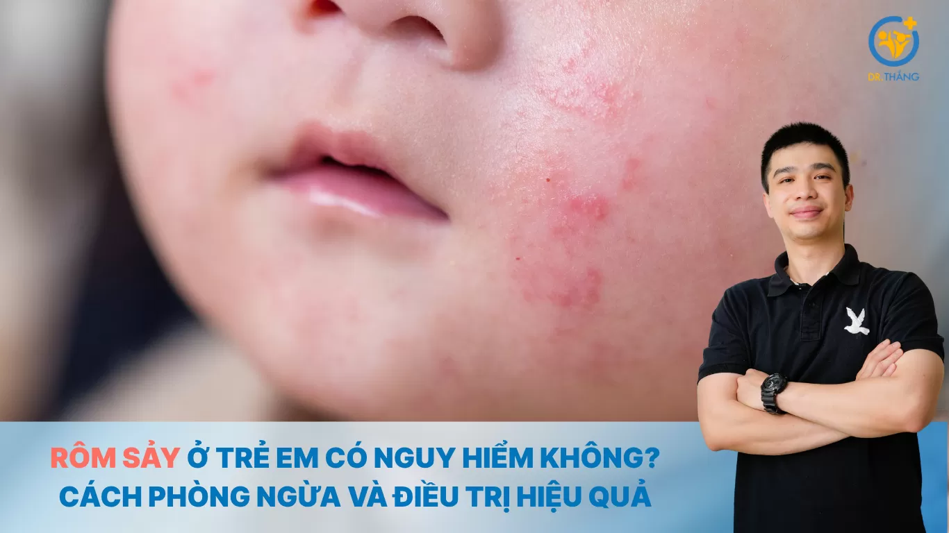 Rôm sảy ở trẻ em có nguy hiểm không? Cách phòng ngừa và điều trị hiệu quả