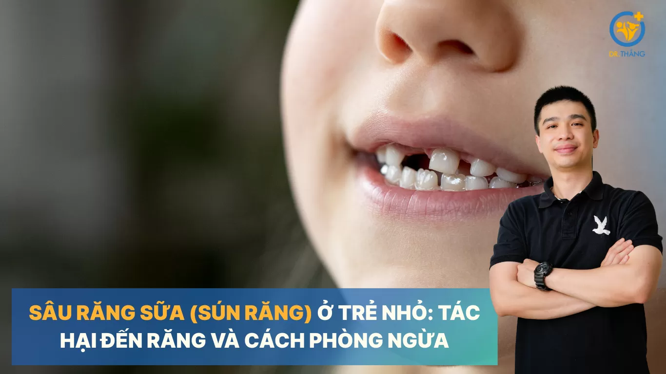 Sâu răng sữa (sún răng) ở trẻ nhỏ: Tác hại đến răng và cách phòng ngừa
